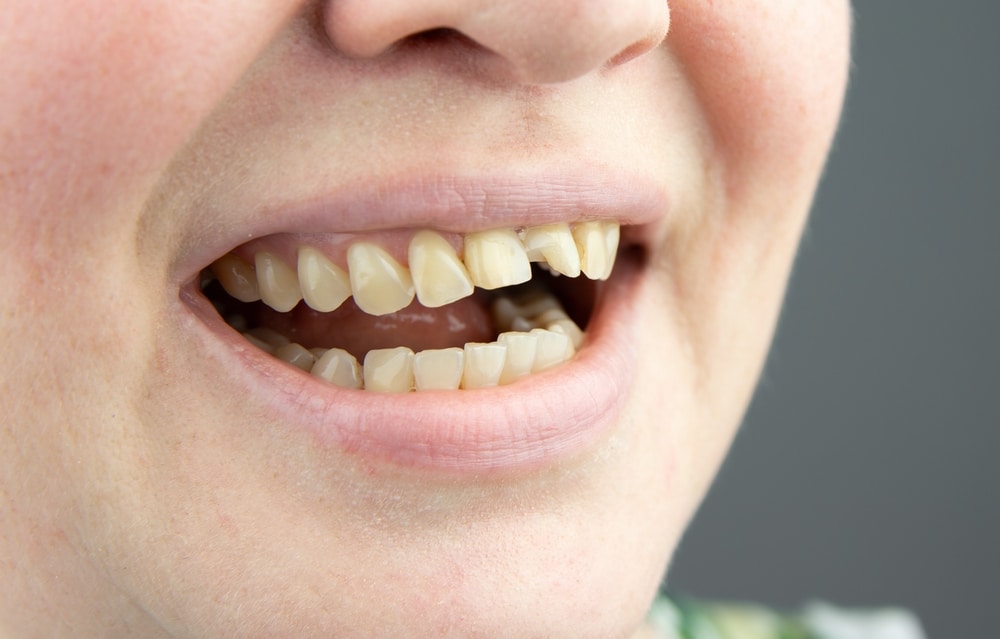 fractured front tooth repair